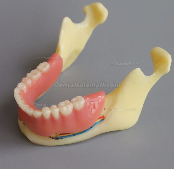 Dental Model #2014 02 - Mandible Implant and Overdenture Demo Model (Yellow)