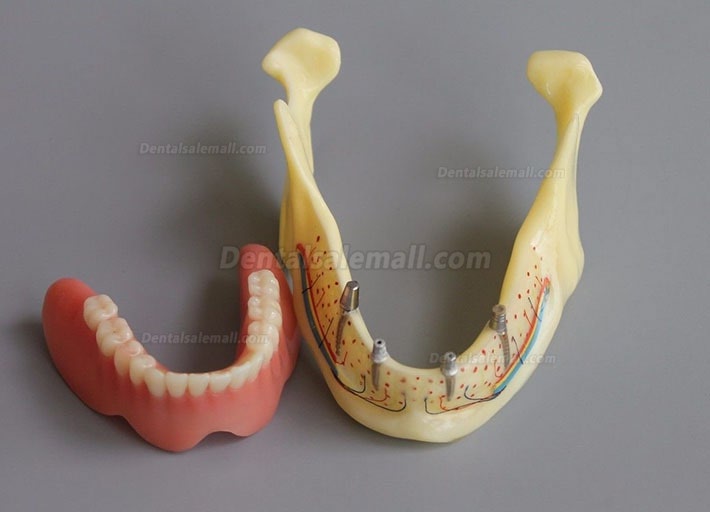 Dental Model #2014 02 - Mandible Implant and Overdenture Demo Model (Yellow)