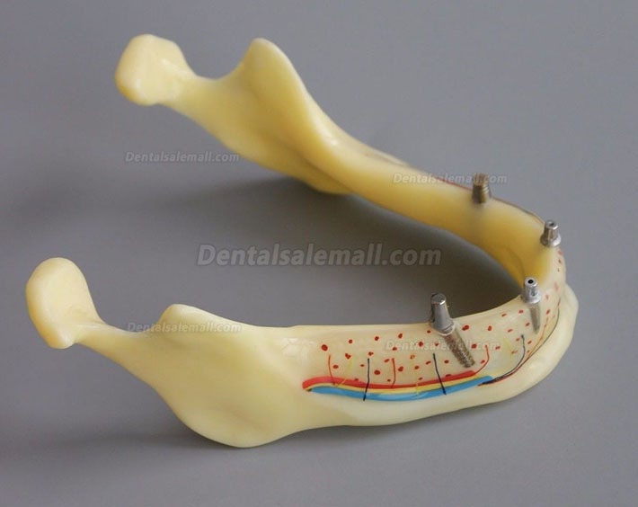 Dental Model #2014 02 - Mandible Implant and Overdenture Demo Model (Yellow)