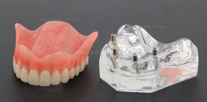 Dental Study Teeth Model Overdenture With 4 Implants Demo Model 6001