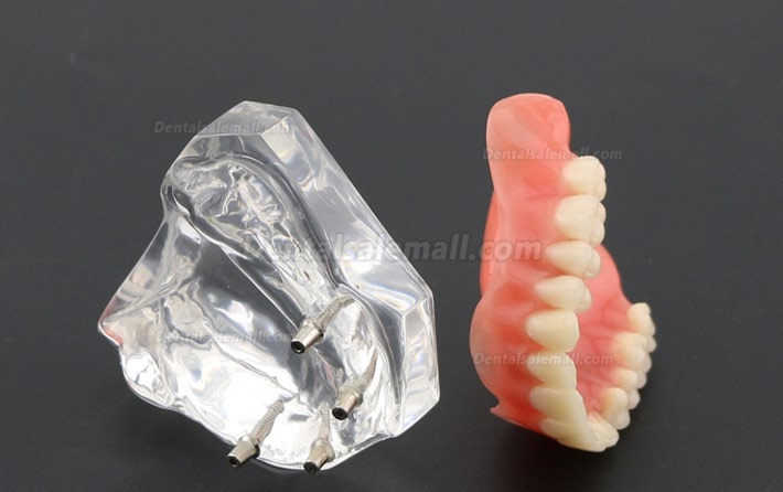 Dental Study Teeth Model Overdenture With 4 Implants Demo Model 6001