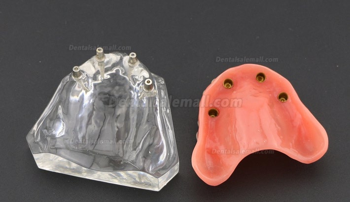 Dental Study Teeth Model Overdenture With 4 Implants Demo Model 6001