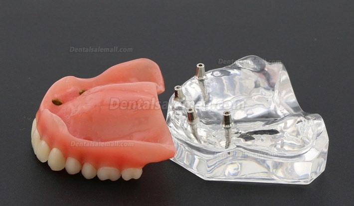 Dental Study Teeth Model Overdenture With 4 Implants Demo Model 6001