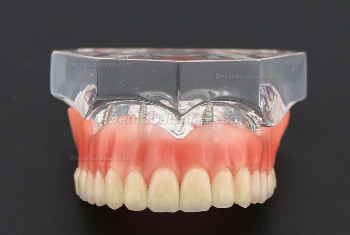 Dental Study Teeth Model Overdenture With 4 Implants Demo Model 6001