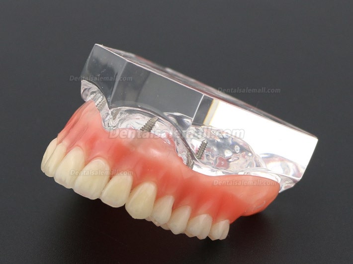 Dental Study Teeth Model Overdenture With 4 Implants Demo Model 6001