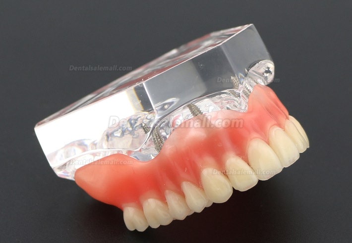 Dental Study Teeth Model Overdenture With 4 Implants Demo Model 6001