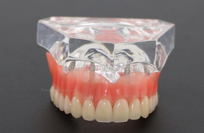 Dental Study Teeth Model Overdenture With 4 Implants Demo Model 6001