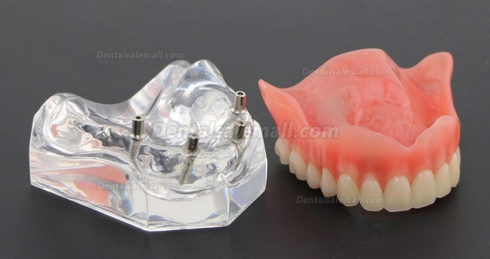 Dental Study Teeth Model Overdenture With 4 Implants Demo Model 6001