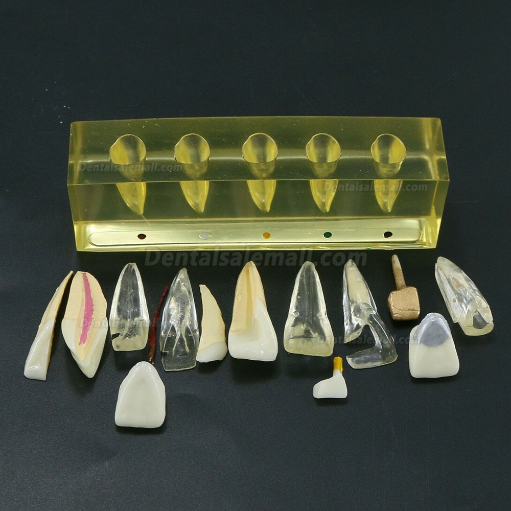 Dental Teeth Model 5 Stages Demonstration Endodontic Treatment Root Canal Incisor