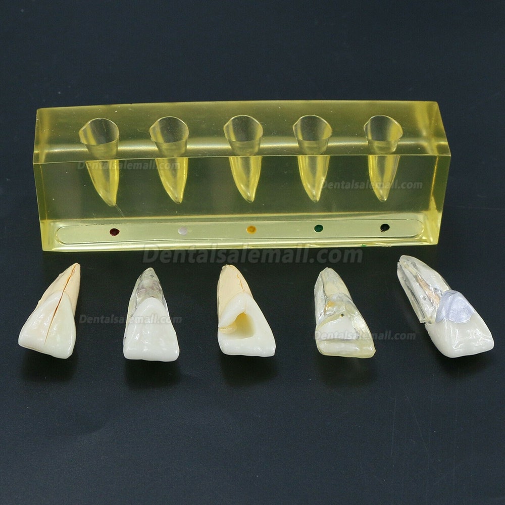 Dental Teeth Model 5Stages Demonstration Endodontic Treatment Root Canal Incisor