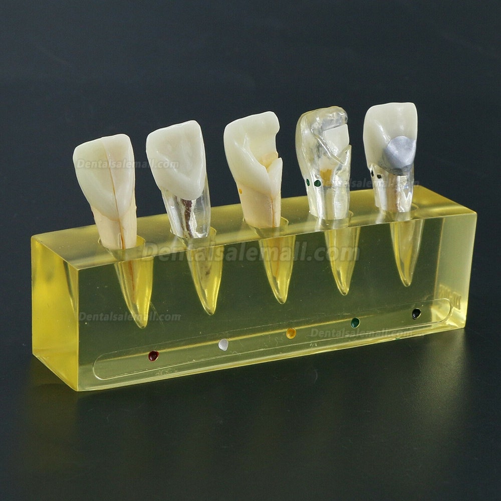 Dental Teeth Model 5Stages Demonstration Endodontic Treatment Root Canal Incisor