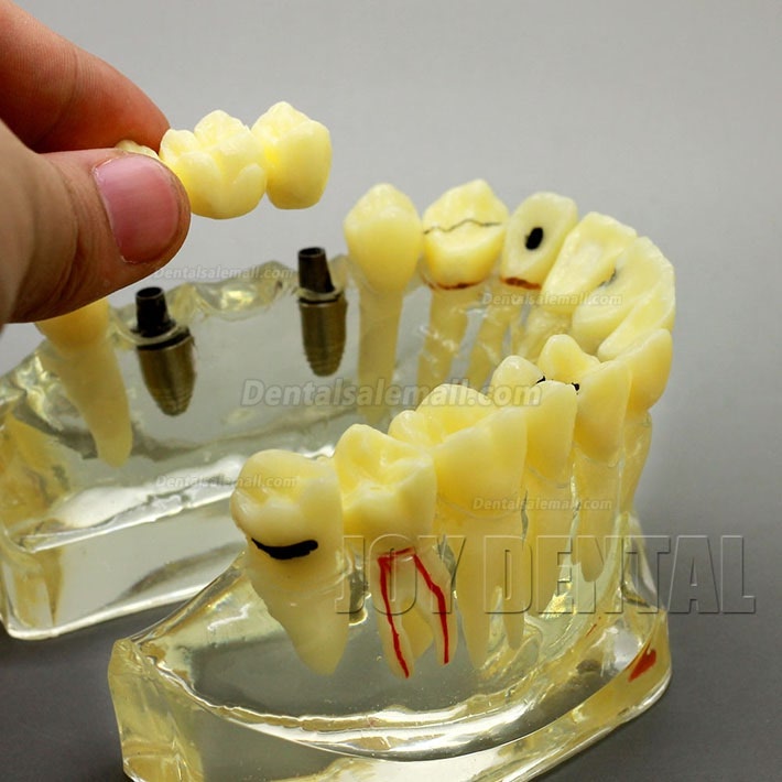 2 Times Enlarged Dental Restoration/ Prothesis/Implant Study model with Bridge