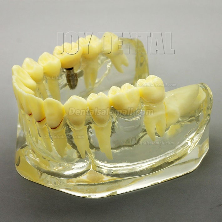 2 Times Enlarged Dental Restoration/ Prothesis/Implant Study model with Bridge