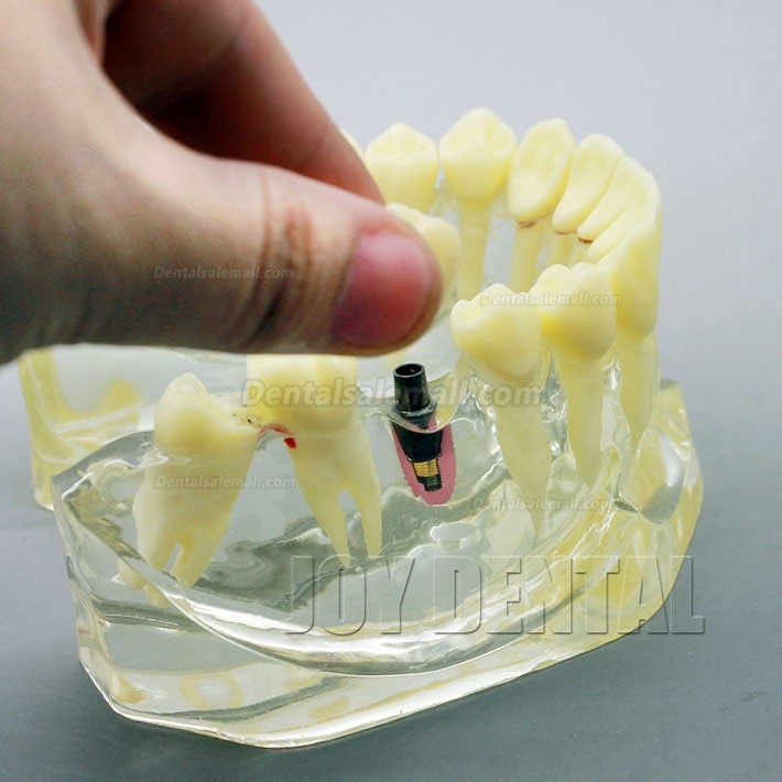 2 Times Enlarged Dental Restoration/ Prothesis/Implant Study model with Bridge