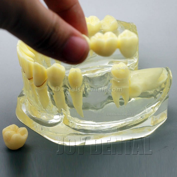 2 Times Enlarged Dental Restoration/ Prothesis/Implant Study model with Bridge