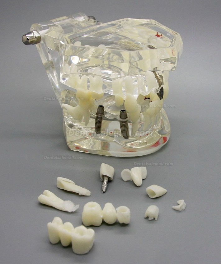 Dental Implant Study Analysis Demonstration Teeth Disease Model with Restoration