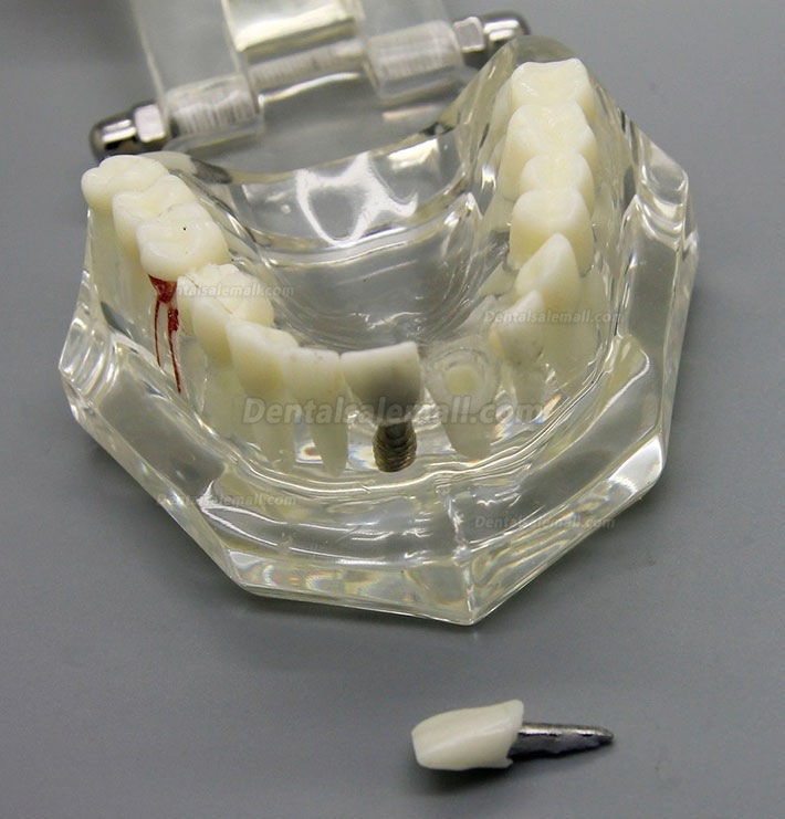 Dental Implant Study Analysis Demonstration Teeth Disease Model with Restoration