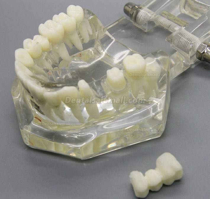 Dental Implant Study Analysis Demonstration Teeth Disease Model with Restoration