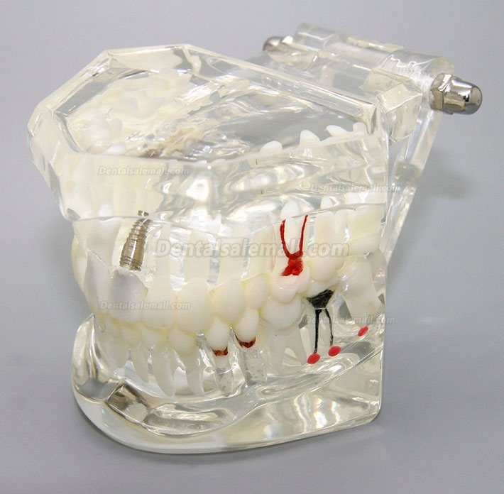 Dental Implant Study Analysis Demonstration Teeth Disease Model with Restoration