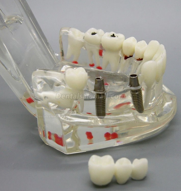 Dental Implant Study Analysis Demonstration Teeth Disease Model with Restoration