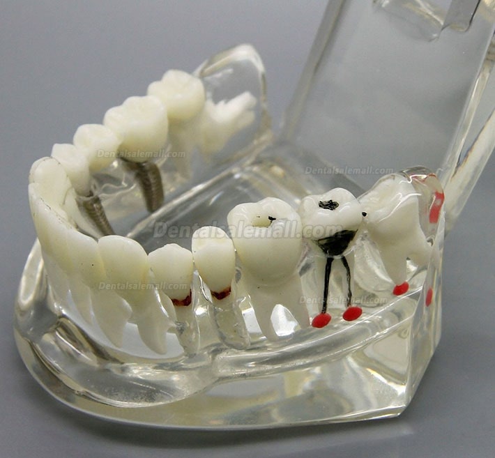 Dental Implant Study Analysis Demonstration Teeth Disease Model with Restoration