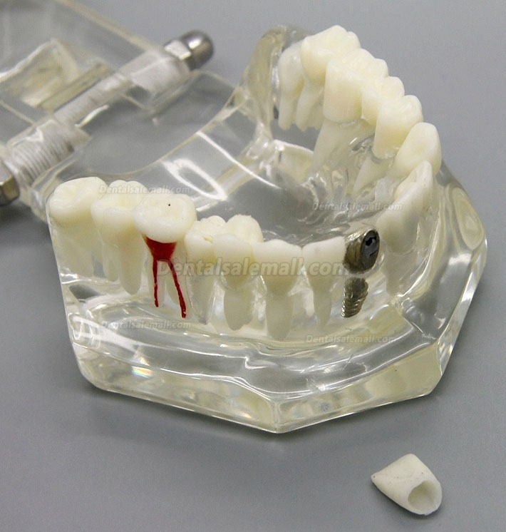 Dental Implant Study Analysis Demonstration Teeth Disease Model with Restoration