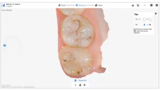 YP-11 Dental 3D Intraoral Scanner with Color Scanning for Restorative, Implant and Orthodontic