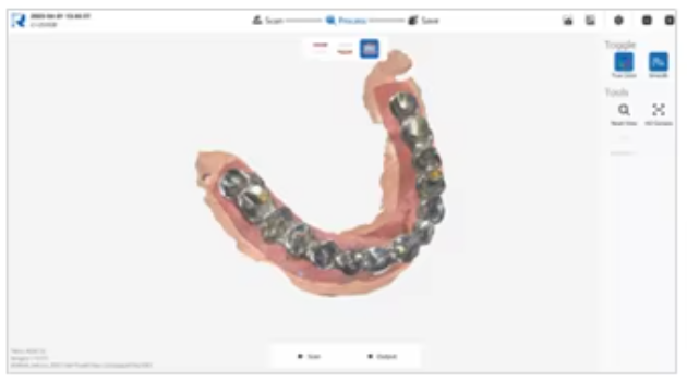 YP-11 Dental 3D Intraoral Scanner with Color Scanning for Restorative, Implant and Orthodontic