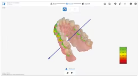 YP-11 Dental 3D Intraoral Scanner with Color Scanning for Restorative, Implant and Orthodontic