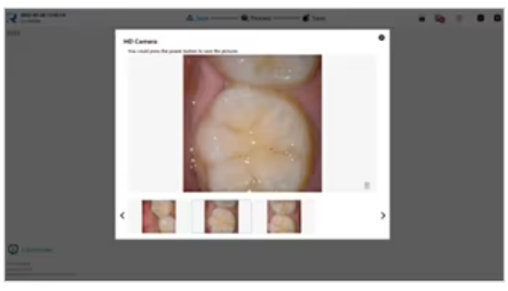 YP-11 Dental 3D Intraoral Scanner with Color Scanning for Restorative, Implant and Orthodontic