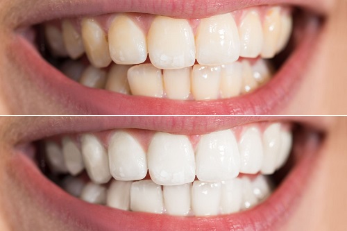 before-and-after-teeth-whitening