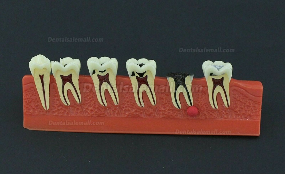 Dental Teeth Disease Model 4 Stages Caries Illustration Typodont 4011 Fit NISSIN