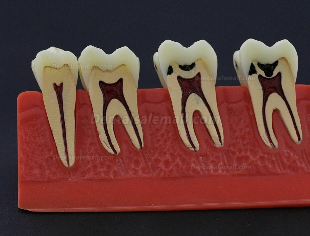 Dental Teeth Disease Model 4 Stages Caries Illustration Typodont 4011 Fit NISSIN