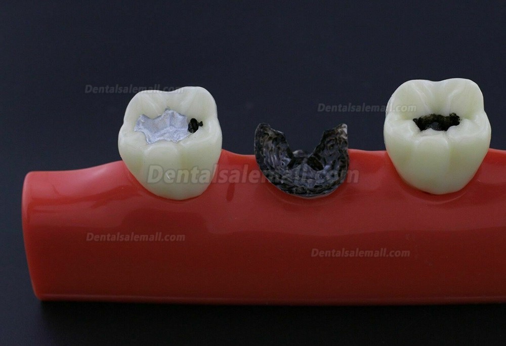 Dental Teeth Disease Model 4 Stages Caries Illustration Typodont 4011 Fit NISSIN