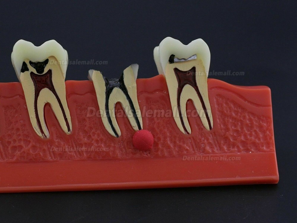 Dental Teeth Disease Model 4 Stages Caries Illustration Typodont 4011 Fit NISSIN