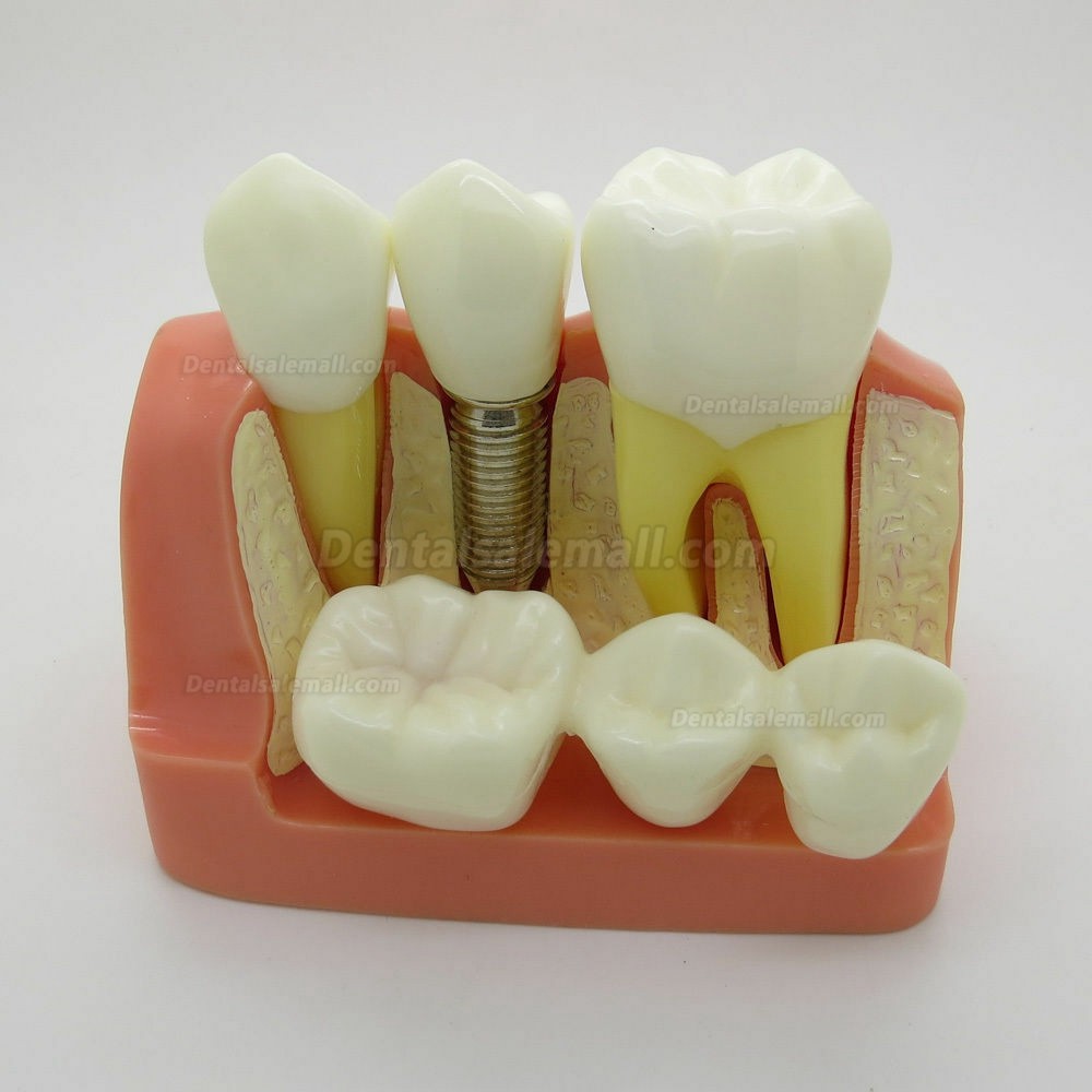 Dental Orthodontics Typodont Implant Analysis Crown Bridge Demonstration Model