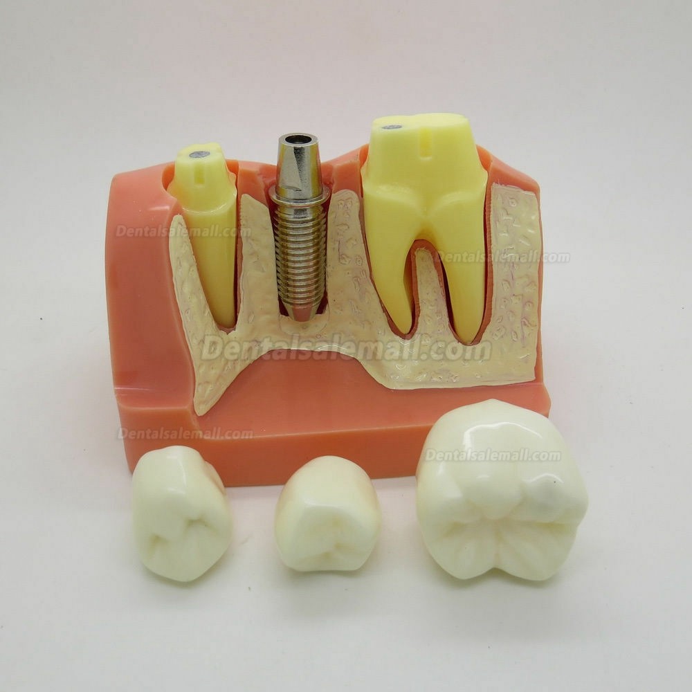 Dental Orthodontics Typodont Implant Analysis Crown Bridge Demonstration Model