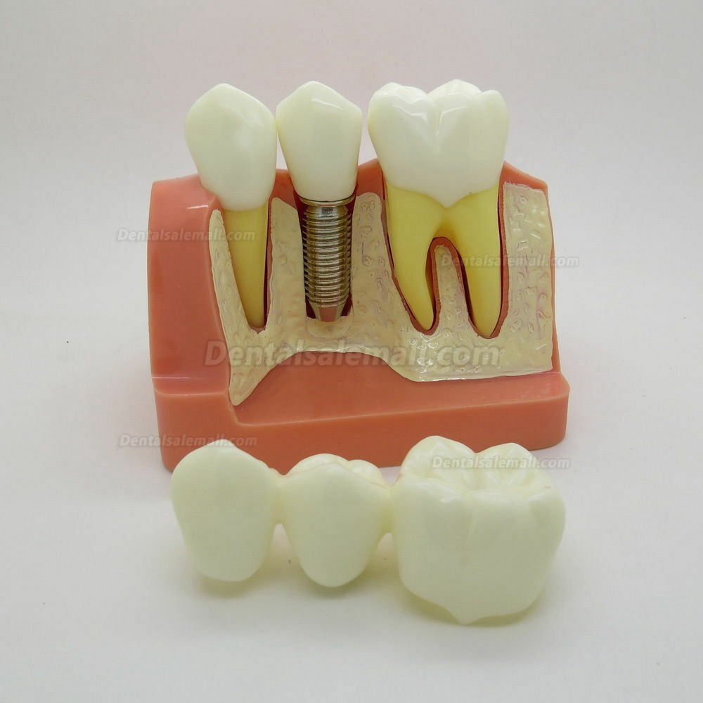 Dental Orthodontics Typodont Implant Analysis Crown Bridge Demonstration Model