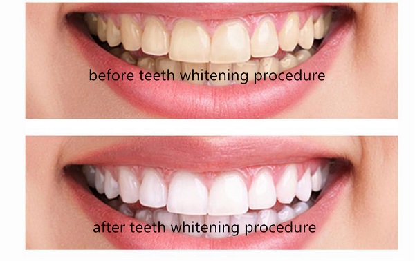 teeth-white