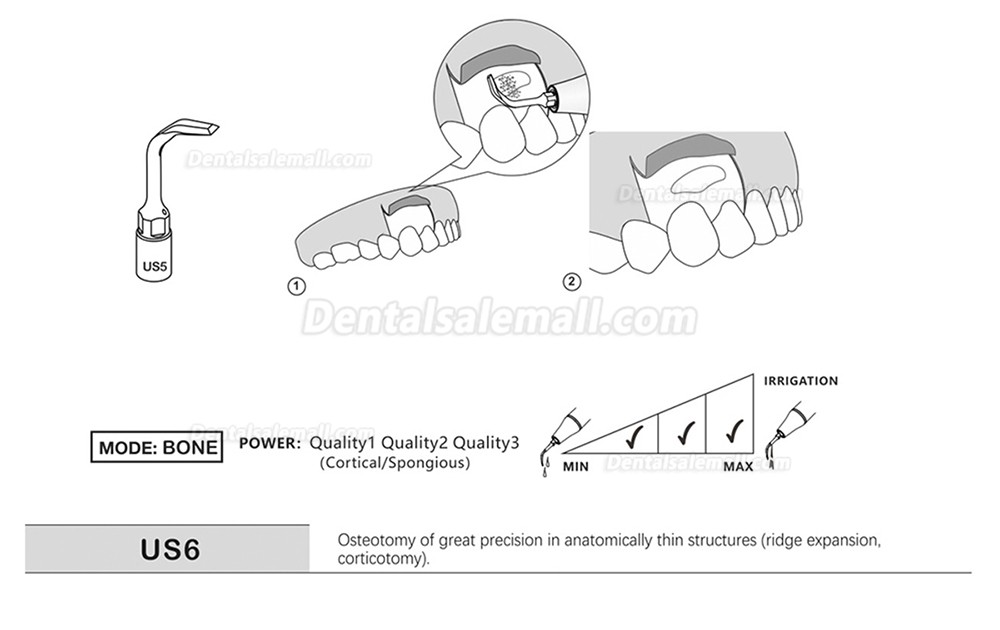 1Pcs Piezosurgery Osteotomy Bone Cutting Dental Surgery Tips US1 US1L US1R US2 US3 US4 US5 US6 US7 US11 US12 Fit Mectron Woodpecker