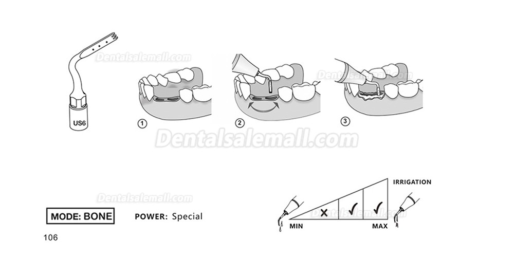 1Pcs Piezosurgery Osteotomy Bone Cutting Dental Surgery Tips US1 US1L US1R US2 US3 US4 US5 US6 US7 US11 US12 Fit Mectron Woodpecker