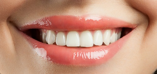 whiten-veneers-dentures