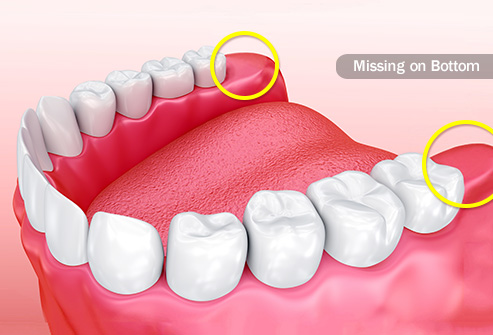 wisdom_teeth_illustration